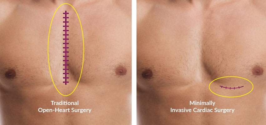 Minimally Invasive Cardiac Surgery (MICS)